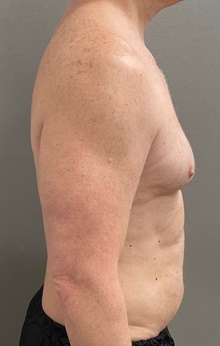 Male Breast Reduction Before Photo by Keshav Magge, MD; Bethesda, MD - Case 49198