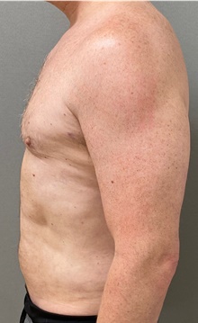 Male Breast Reduction After Photo by Keshav Magge, MD; Bethesda, MD - Case 49198