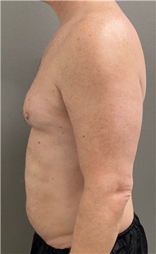 Male Breast Reduction Before Photo by Keshav Magge, MD; Bethesda, MD - Case 49198