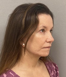 Facelift After Photo by Keshav Magge, MD; Bethesda, MD - Case 49203