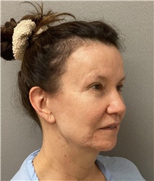 Facelift Before Photo by Keshav Magge, MD; Bethesda, MD - Case 49203