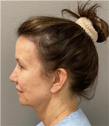 Facelift Before Photo by Keshav Magge, MD; Bethesda, MD - Case 49203