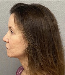 Neck Lift After Photo by Keshav Magge, MD; Bethesda, MD - Case 49204