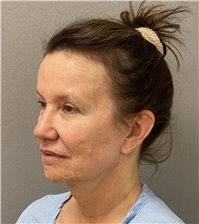 Neck Lift Before Photo by Keshav Magge, MD; Bethesda, MD - Case 49204