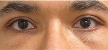 Eyelid Surgery After Photo by Keshav Magge, MD; Bethesda, MD - Case 49205