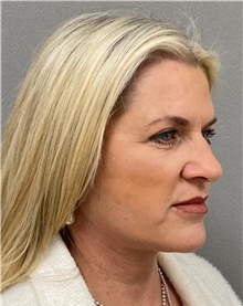 Facelift After Photo by Keshav Magge, MD; Bethesda, MD - Case 49211