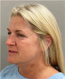 Facelift Before Photo by Keshav Magge, MD; Bethesda, MD - Case 49211