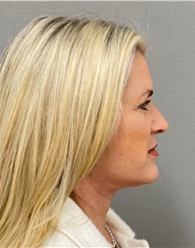 Facelift After Photo by Keshav Magge, MD; Bethesda, MD - Case 49211