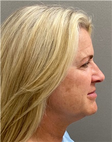 Facelift Before Photo by Keshav Magge, MD; Bethesda, MD - Case 49211