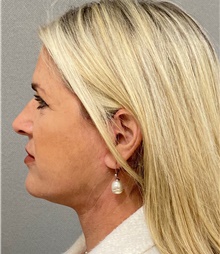 Facelift After Photo by Keshav Magge, MD; Bethesda, MD - Case 49211