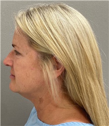 Facelift Before Photo by Keshav Magge, MD; Bethesda, MD - Case 49211