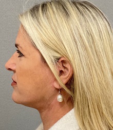 Neck Lift After Photo by Keshav Magge, MD; Bethesda, MD - Case 49212