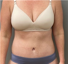 Tummy Tuck After Photo by Keshav Magge, MD; Bethesda, MD - Case 49213