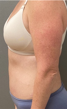 Tummy Tuck After Photo by Keshav Magge, MD; Bethesda, MD - Case 49213