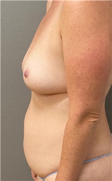 Tummy Tuck Before Photo by Keshav Magge, MD; Bethesda, MD - Case 49213