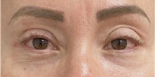 Eyelid Surgery After Photo by Keshav Magge, MD; Bethesda, MD - Case 49214