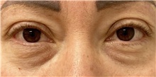 Eyelid Surgery Before Photo by Keshav Magge, MD; Bethesda, MD - Case 49214