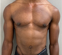 Male Breast Reduction After Photo by Keshav Magge, MD; Bethesda, MD - Case 49217