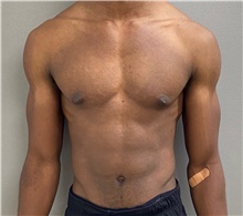 Male Breast Reduction Before Photo by Keshav Magge, MD; Bethesda, MD - Case 49217