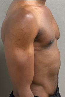 Male Breast Reduction After Photo by Keshav Magge, MD; Bethesda, MD - Case 49217