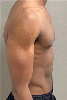 Male Breast Reduction Before Photo by Keshav Magge, MD; Bethesda, MD - Case 49217