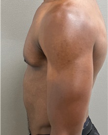 Male Breast Reduction After Photo by Keshav Magge, MD; Bethesda, MD - Case 49217