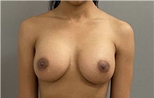 Breast Augmentation After Photo by Keshav Magge, MD; Bethesda, MD - Case 49218