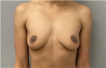 Breast Augmentation Before Photo by Keshav Magge, MD; Bethesda, MD - Case 49218