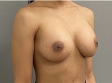 Breast Augmentation After Photo by Keshav Magge, MD; Bethesda, MD - Case 49218