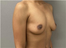 Breast Augmentation Before Photo by Keshav Magge, MD; Bethesda, MD - Case 49218