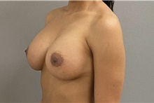 Breast Augmentation After Photo by Keshav Magge, MD; Bethesda, MD - Case 49218