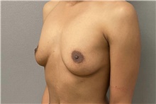 Breast Augmentation Before Photo by Keshav Magge, MD; Bethesda, MD - Case 49218