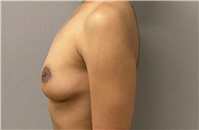 Breast Augmentation Before Photo by Keshav Magge, MD; Bethesda, MD - Case 49218