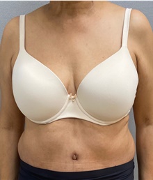 Tummy Tuck After Photo by Keshav Magge, MD; Bethesda, MD - Case 49219