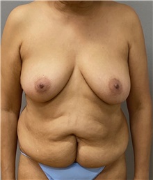 Tummy Tuck Before Photo by Keshav Magge, MD; Bethesda, MD - Case 49219