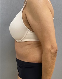 Tummy Tuck After Photo by Keshav Magge, MD; Bethesda, MD - Case 49219