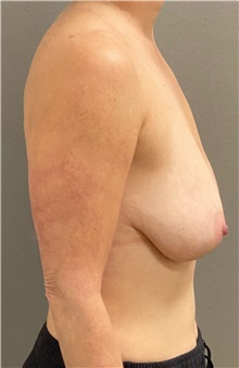 Breast Lift Before Photo by Keshav Magge, MD; Bethesda, MD - Case 49220