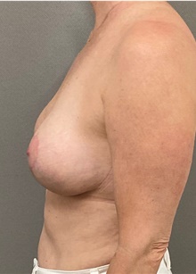 Breast Lift After Photo by Keshav Magge, MD; Bethesda, MD - Case 49220