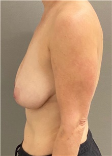 Breast Lift Before Photo by Keshav Magge, MD; Bethesda, MD - Case 49220