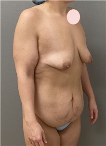 Breast Lift Before Photo by Keshav Magge, MD; Bethesda, MD - Case 49221