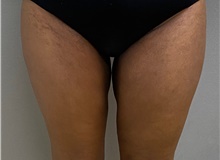 Liposuction After Photo by Keshav Magge, MD; Bethesda, MD - Case 49232