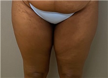 Liposuction Before Photo by Keshav Magge, MD; Bethesda, MD - Case 49232