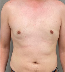 Male Breast Reduction After Photo by Keshav Magge, MD; Bethesda, MD - Case 49238