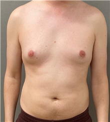 Male Breast Reduction Before Photo by Keshav Magge, MD; Bethesda, MD - Case 49238