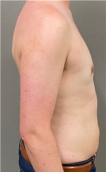 Male Breast Reduction After Photo by Keshav Magge, MD; Bethesda, MD - Case 49238