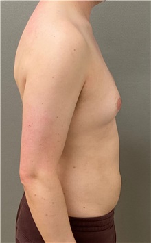 Male Breast Reduction Before Photo by Keshav Magge, MD; Bethesda, MD - Case 49238