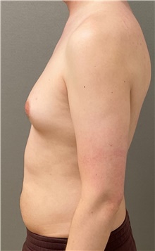 Male Breast Reduction Before Photo by Keshav Magge, MD; Bethesda, MD - Case 49238