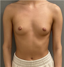 Breast Augmentation Before Photo by Keshav Magge, MD; Bethesda, MD - Case 49239