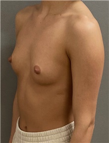 Breast Augmentation Before Photo by Keshav Magge, MD; Bethesda, MD - Case 49239