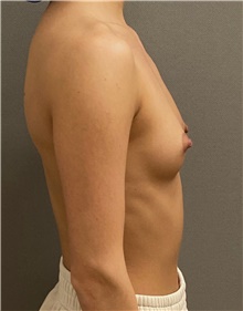 Breast Augmentation Before Photo by Keshav Magge, MD; Bethesda, MD - Case 49239